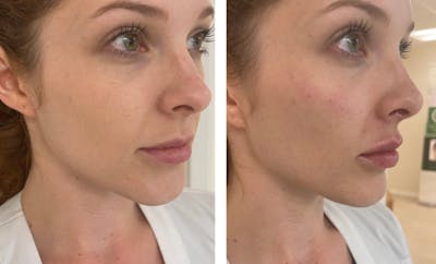 Lip Fillers Before & After Gallery - Patient 177166875 - Image 1