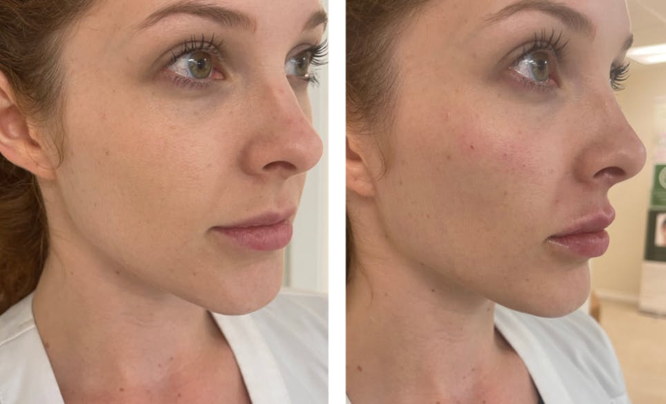 Cheek Contour Before & After Gallery - Patient 177166871 - Image 1