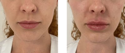 Lip Fillers Before & After Gallery - Patient 177168477 - Image 1