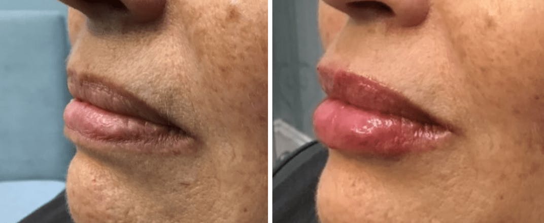 Lip Fillers Before & After Gallery - Patient 177168479 - Image 1