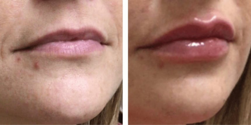 Lip Fillers Before & After Gallery - Patient 177168480 - Image 1