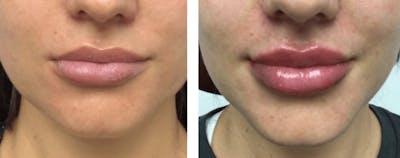 Lip Fillers Before & After Gallery - Patient 177168485 - Image 1