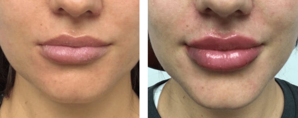 Lip Fillers Before & After Gallery - Patient 177168485 - Image 1