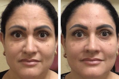 BOTOX Before & After Gallery - Patient 177168637 - Image 1