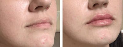 Lip Fillers Before & After Gallery - Patient 177168642 - Image 1