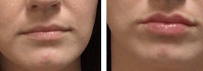 Lip Fillers Before & After Gallery - Patient 177169066 - Image 1