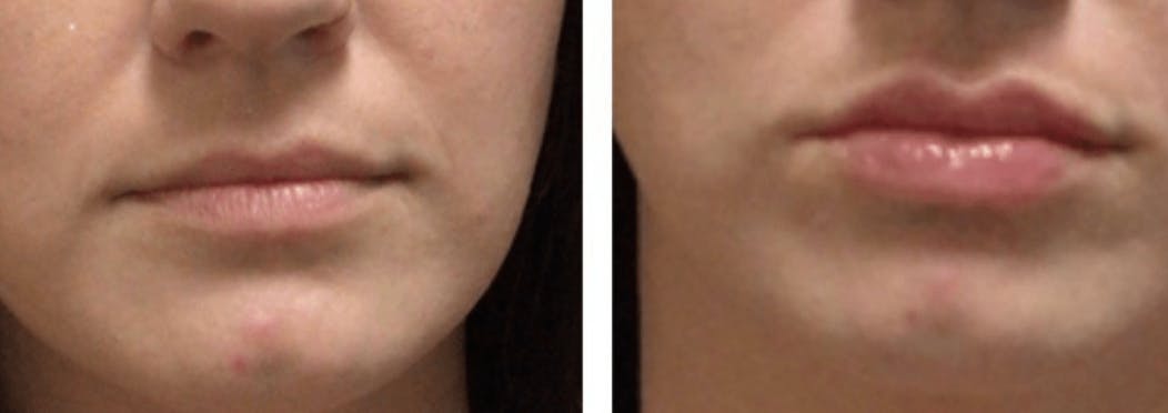 Lip Fillers Before & After Gallery - Patient 177169066 - Image 1