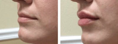 Lip Fillers Before & After Gallery - Patient 177169067 - Image 1