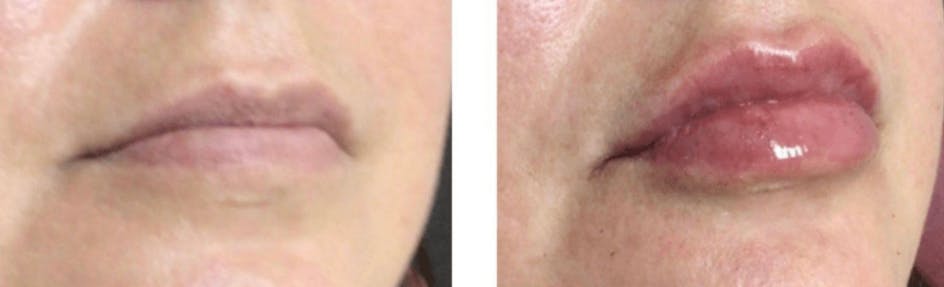 Lip Fillers Before & After Gallery - Patient 177169205 - Image 1