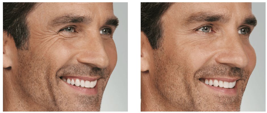 BOTOX Before & After Gallery - Patient 177169263 - Image 1