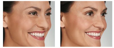BOTOX Before & After Gallery - Patient 177169277 - Image 1