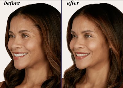 BOTOX Before & After Gallery - Patient 177169279 - Image 1