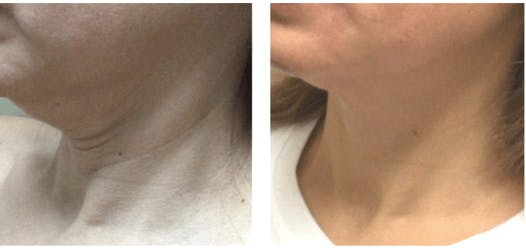 BOTOX Before & After Gallery - Patient 177169280 - Image 1