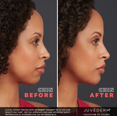 Liquid Chin & Jaw Contouring Before & After Gallery - Patient 177169281 - Image 1