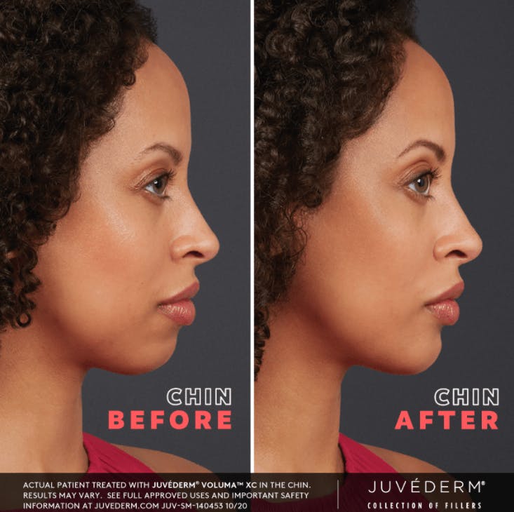 JUVÉDERM Before & After Gallery - Patient 177169538 - Image 1