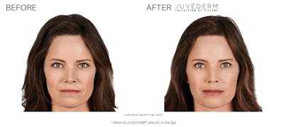 JUVÉDERM Before & After Gallery - Patient 177169540 - Image 1