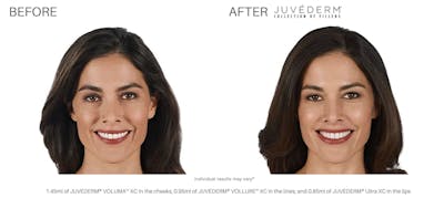 JUVÉDERM Before & After Gallery - Patient 177169543 - Image 1