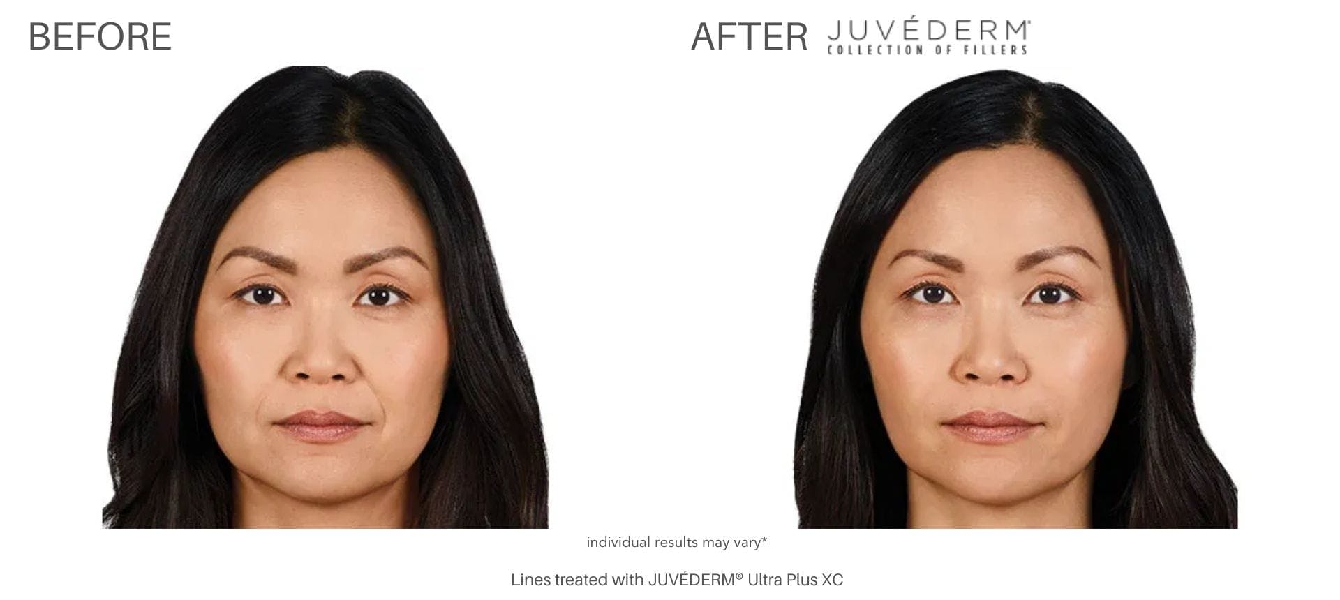 JUVÉDERM Before & After Gallery - Patient 177169546 - Image 1