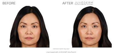 JUVÉDERM Before & After Gallery - Patient 177169546 - Image 1