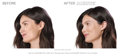 JUVÉDERM Before & After Gallery - Patient 177169548 - Image 1