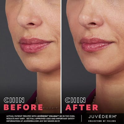 Liquid Chin & Jaw Contouring Before & After Gallery - Patient 177169814 - Image 1