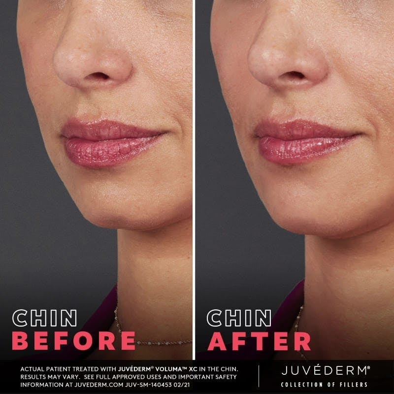 JUVÉDERM Before & After Gallery - Patient 177169552 - Image 1
