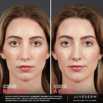 JUVÉDERM Before & After Gallery - Patient 177169844 - Image 1