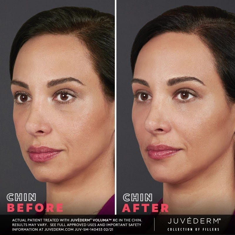 JUVÉDERM Before & After Gallery - Patient 177169850 - Image 1