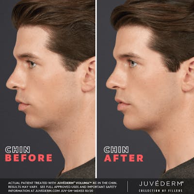 Liquid Chin & Jaw Contouring Before & After Gallery - Patient 177169852 - Image 1