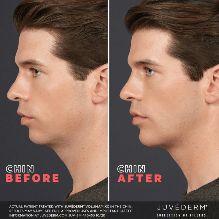 JUVÉDERM Before & After Gallery - Patient 177169851 - Image 1