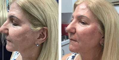 Restylane Before & After Gallery - Patient 177169860 - Image 1