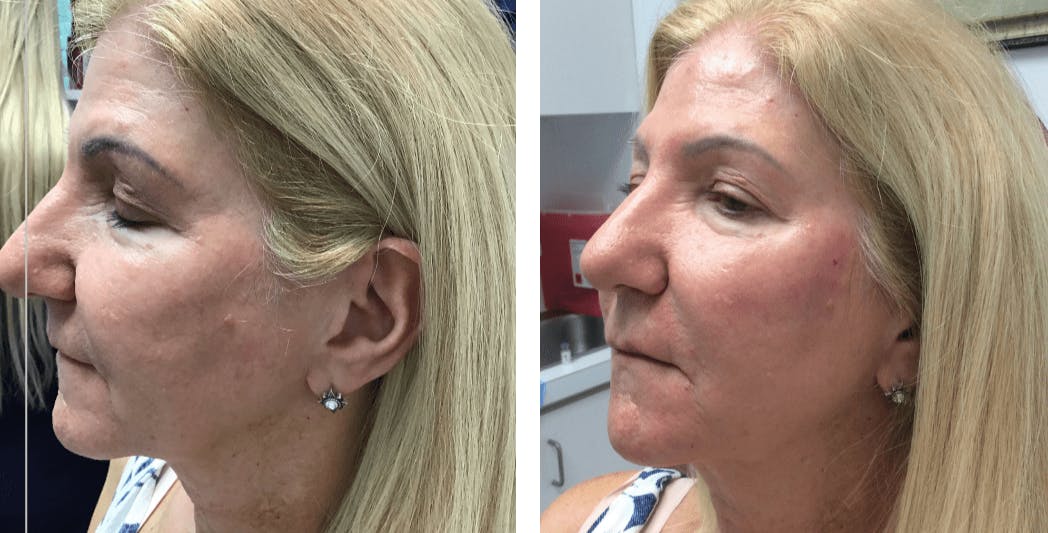 Restylane Before & After Gallery - Patient 177169860 - Image 1