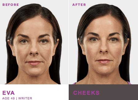 Cheek Contour Before & After Gallery - Patient 177169911 - Image 1