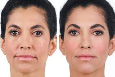 Dermal Filler Before & After Gallery - Patient 177170477 - Image 1