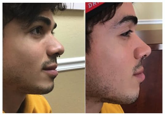 Liquid Rhinoplasty Before & After Gallery - Patient 177170495 - Image 1