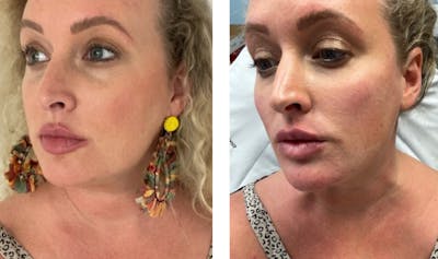 Cheek Contour Before & After Gallery - Patient 176820531 - Image 1