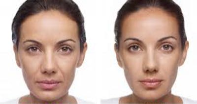 Dermal Filler Before & After Gallery - Patient 177170474 - Image 1