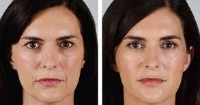 Dermal Filler Before & After Gallery - Patient 177170476 - Image 1