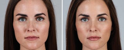 JUVÉDERM Before & After Gallery - Patient 177170482 - Image 1