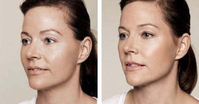 JUVÉDERM Before & After Gallery - Patient 177170483 - Image 1