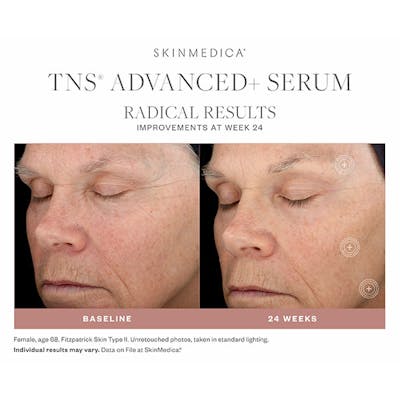 SkinMedica Before & After Gallery - Patient 177174510 - Image 1