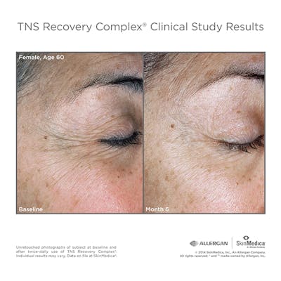 SkinMedica Before & After Gallery - Patient 177174511 - Image 1