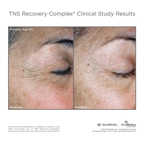 SkinMedica Before & After Gallery - Patient 177174511 - Image 1