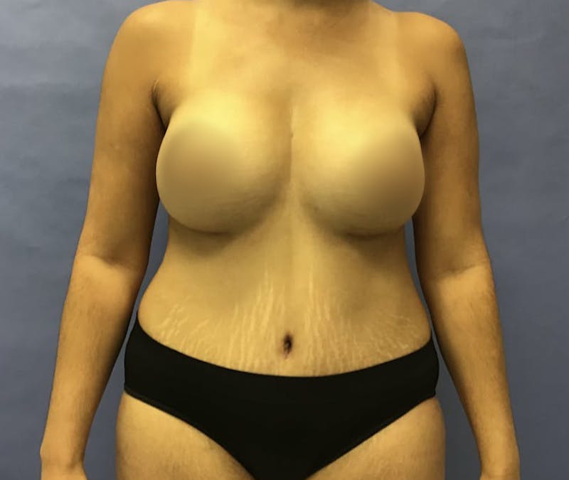 Tummy Tuck Before & After Gallery - Patient 175151770 - Image 2