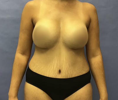 Tummy Tuck Before & After Gallery - Patient 175151770 - Image 2