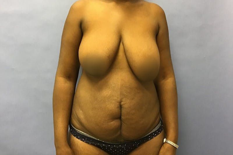 Liposuction Before & After Gallery - Patient 175151963 - Image 1