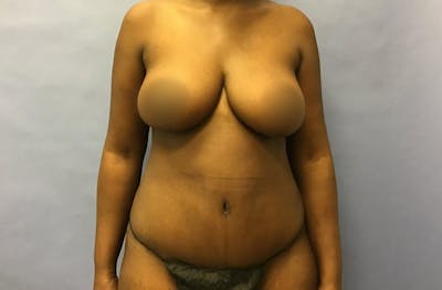 Liposuction Before & After Gallery - Patient 175151963 - Image 2