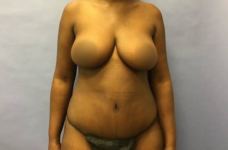 Liposuction Before & After Gallery - Patient 175151963 - Image 2