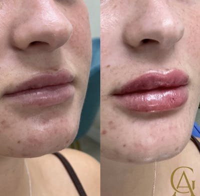 Lip Fillers Before & After Gallery - Patient 187063733 - Image 1