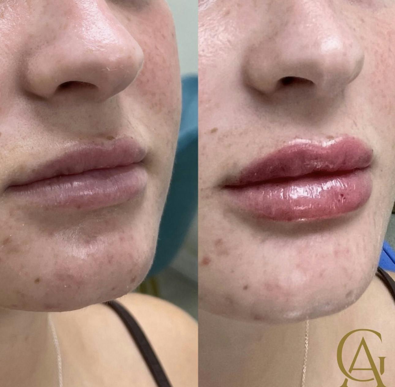 Lip Fillers Before & After Gallery - Patient 187063733 - Image 1